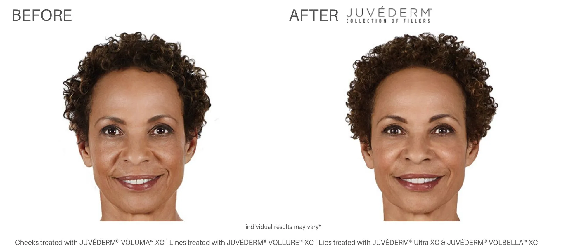 juvederm lip filler
