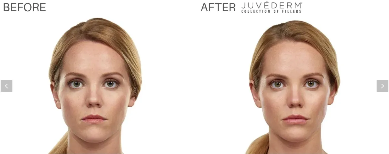 juvederm lip filler