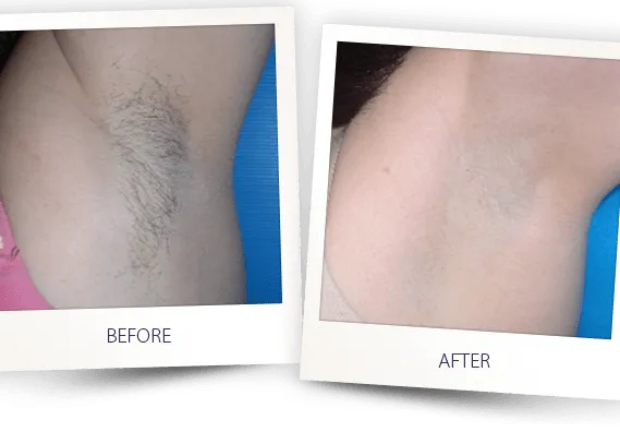 laser hair removal underarms