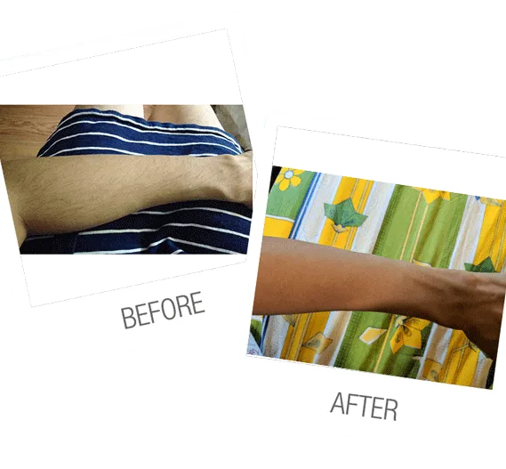 laser hair removal 2