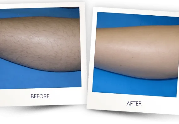 laser hair removal 1
